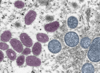 First suspected monkeypox case in California Eligible people in Contra Costa can now schedule monkeypox vaccination